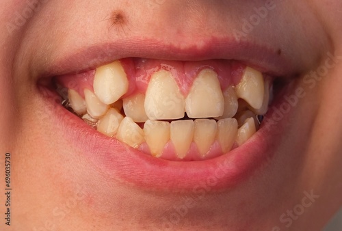 A close-up shot of teenager smile with crooked teeth