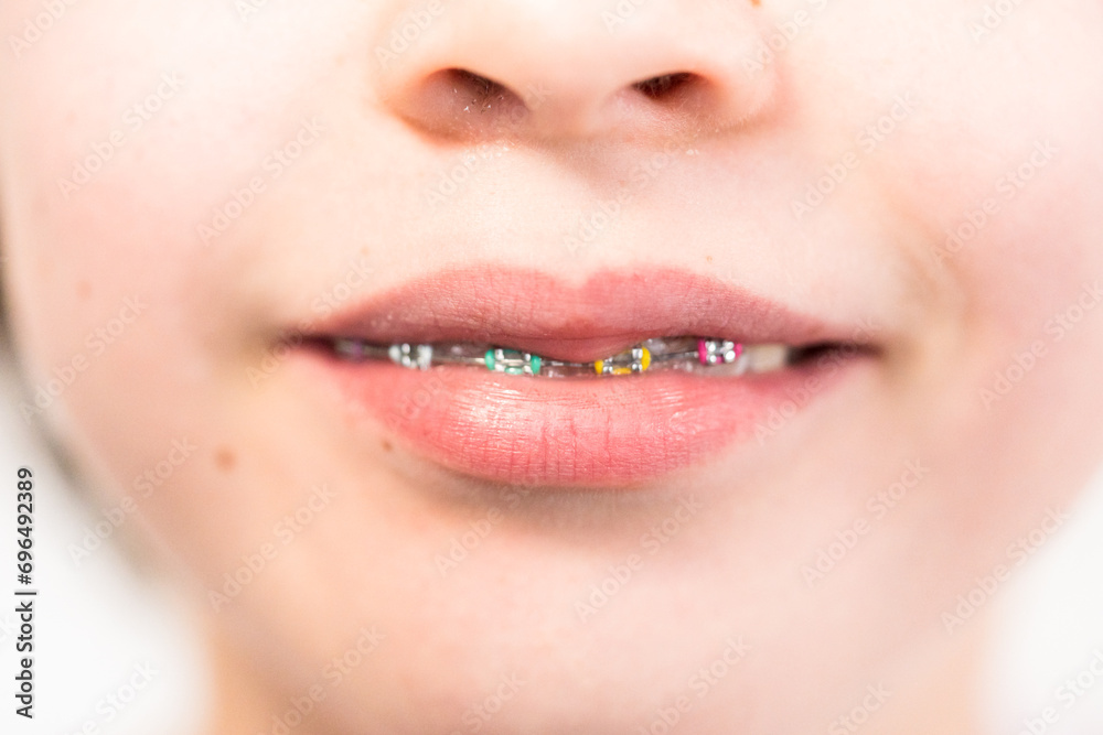 Naklejka premium Little girl with rainbow braces