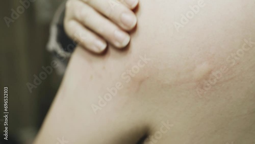 A woman has pimples on her skin and an allergic reaction. She scratches the skin on her shoulder with her hand. photo