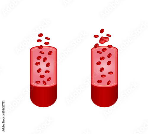  Thromboembolism. Circulating blood clot. Normal blood flow and a thrombus in blood flow, embolus. Red blood cell. Vector illustration.