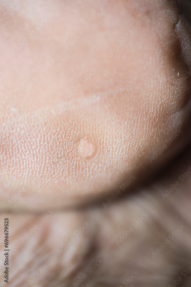 Fototapeta premium The skin of a person's feet has the appearance of wounds, corns, calluses, and blemishes.