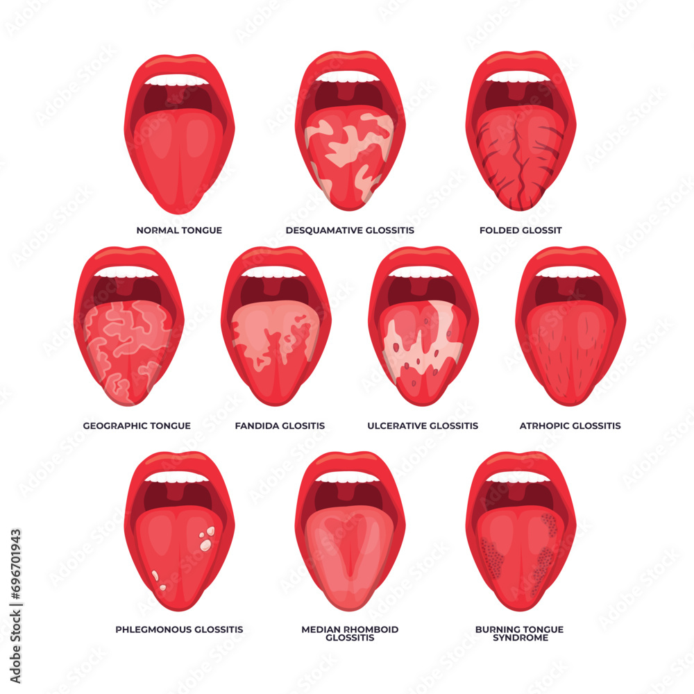 Set of different types of glossitis collection, Diagram of tongue disease in different stages for infographic biology education school, Candidiasis of the tongue, thrush. Inflammation of the tongue. - obrazy, fototapety, plakaty 
