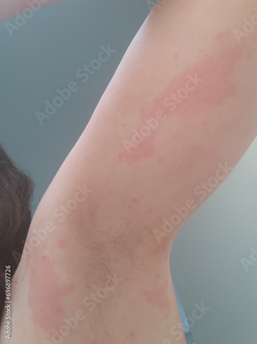 Female body affected by a severe allergic reaction, dermatitis