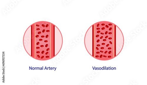 Arterial vasodilation. Cross section of arteries. Comparison of normal,  and dilated blood vessels. Scientific Diagram. Vector illustration.