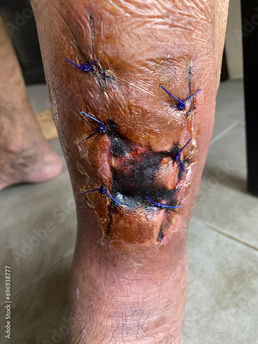 Pasca debridement treatment of infected wound of diabetes foot medical with inflammation effect and sewing wounds, blood tissue healing skin photo