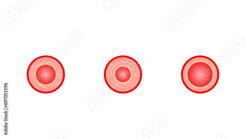 Arterial vasoconstriction and vasodilation. Cross section of arteries. Comparison of normal, constricted, and dilated blood vessels. Scientific Diagram. Vector illustration.
