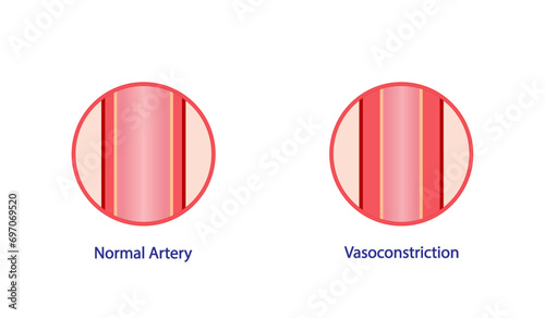 Arterial vasoconstriction and vasodilation. Cross section of arteries. Comparison of normal, constricted, and dilated blood vessels. Scientific Diagram. Vector illustration.