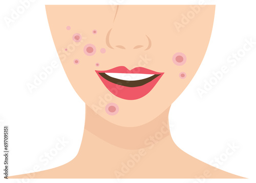 Young woman face with skin acne, pimples, blackheads vector illustration. Acne skin face problem concept