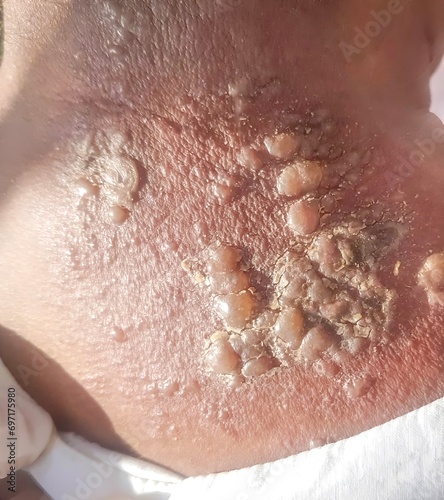 Herpes simplex infection at nape. Small and painful vesicles. photo