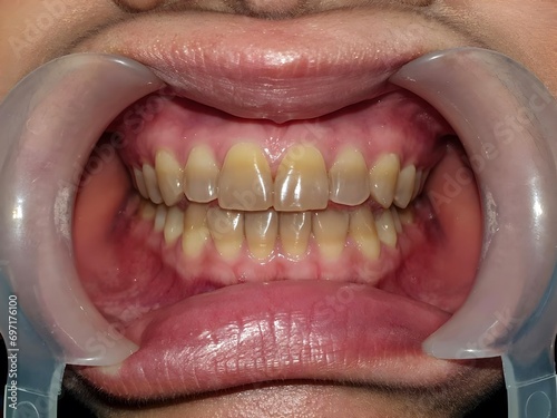 Closeup of teeth with tetracycline staining. photo