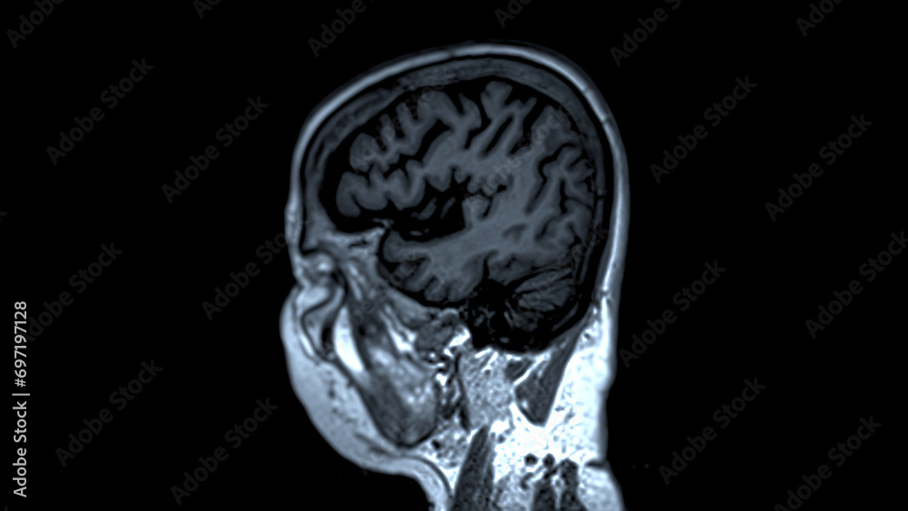 MRI brain scans sagittal view offer valuable insights into brain