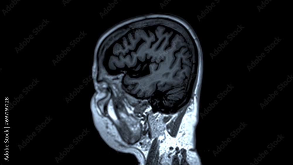 MRI brain scans sagittal view offer valuable insights into brain MRI brain scans sagittal view offer valuable insights into brain