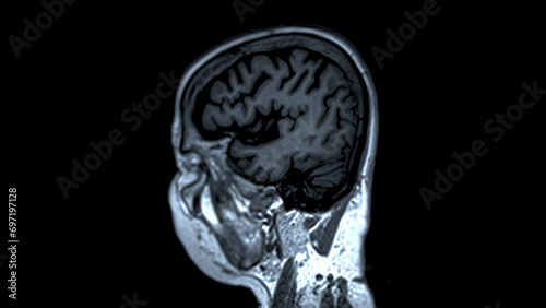 MRI brain scans sagittal view offer valuable insights into brain photo