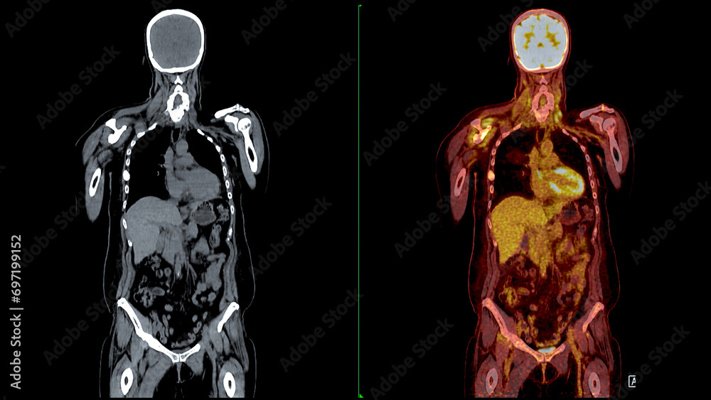 PET CT Scan fusion image It provides detailed images by merging Stock ...