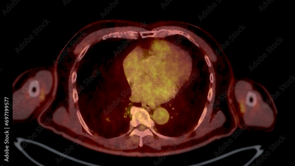 PET CT Scan fusion image It provides detailed images by merging Stock ...