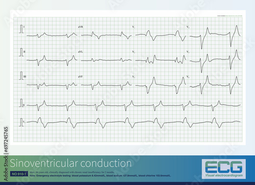 When the blood potassium concentration significantly increases, it can inhibit ventricular conduction, cause diffuse intraventricular block, and generate wide QRS waves and sinoventricular conduction.