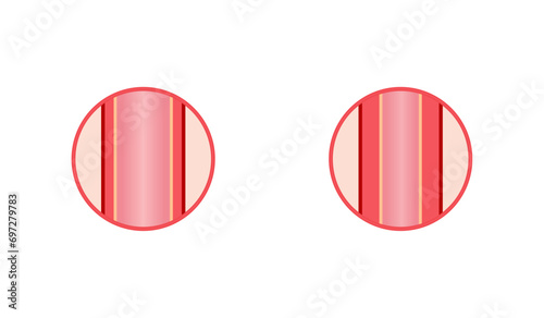 Arterial vasoconstriction and vasodilation. Cross section of arteries. Comparison of normal, constricted, and dilated blood vessels. Scientific Diagram. Vector illustration.