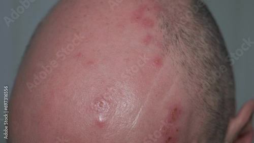 Man with painful shingles virus. Scabs and blisters on his face, head and above his eye.  photo