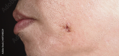 Scars from facial abscess or big acne surgery. Scars from inflammation of the skin after medical treatment. Close up scars or problem skin on face. Photo after treatment for big abscess and acne. 