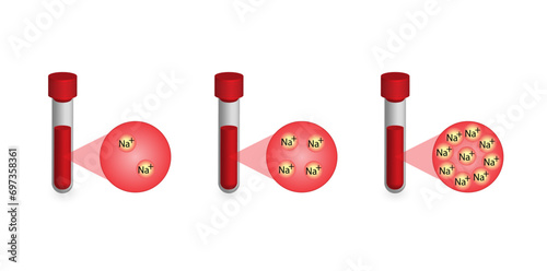  Hypernatremia, high plasma sodium level and Hyponatremia, low plasma sodium level. Sodium Na excess and deficit electrolyte disorders, blood test tube, Scientific design. Vector illustration.
