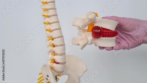 Convex red intervertebral disc herniation on model of spine. Treatment of problems and diseases of spine photo
