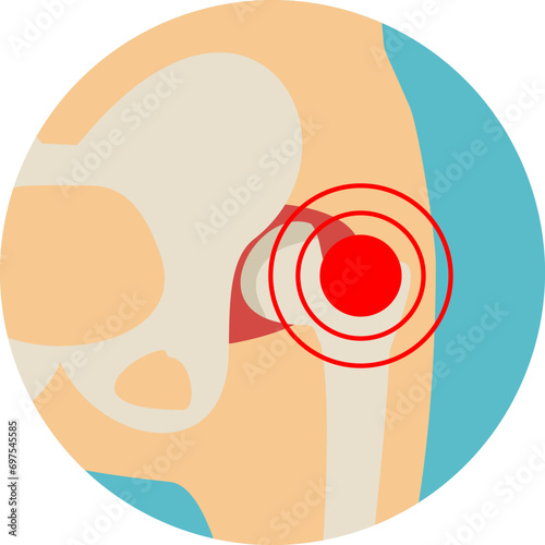 Hip joint structure. Arthritis of the hip joint. Hip Osteoarthritis Icon. Pain, fracture or inflammation in pelvis. Front view. Flat vector illustration.