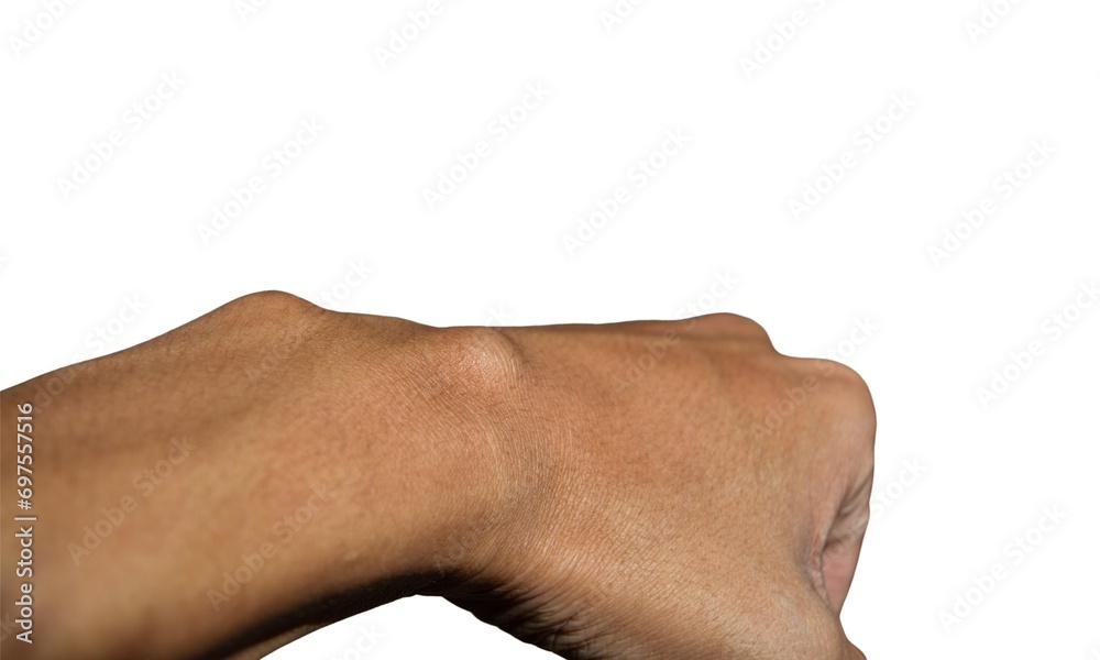 Higrom Female hand with a hygroma. Pain. Wrist ganglion cyst. Computer mouse ...