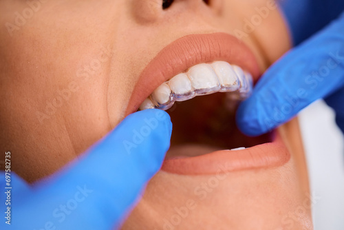 Close up of dentist applying invisible aligners on woman's teeth during appointment at dental clinic.