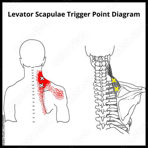Levator Scapulae Trigger Point Diagram, Trigger Point Diagrams