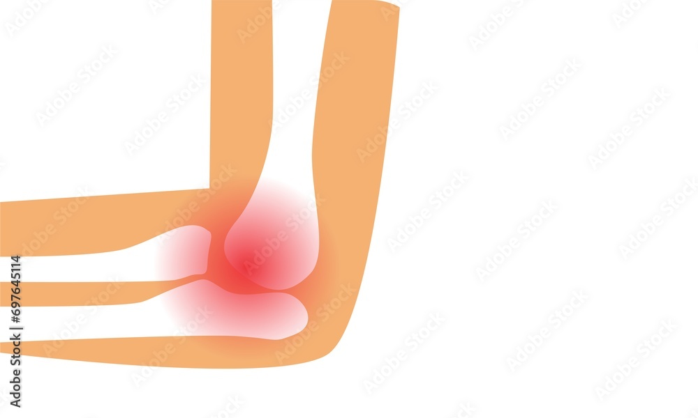 Ilustrace „Golfer's elbow pain sport injury in pronation wrist common