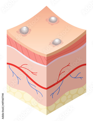 Skincare medical concept. Problems in cross-section of human skin horizontal layers structure. Anatomy illustrative model unhealthy layer of skin