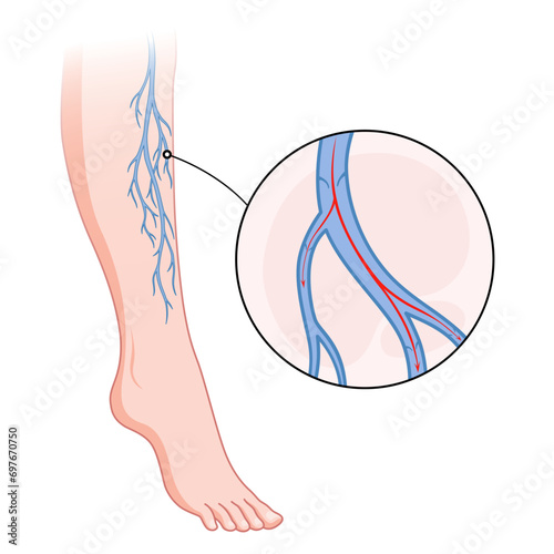 Varicose veins. Blue blood vessel visible through the skin, abnormally swollen leg. Vascular disease diagnostic and treatment. Venous insufficiency medical disease