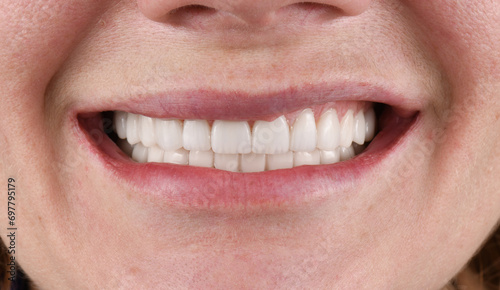 ceramic veneers