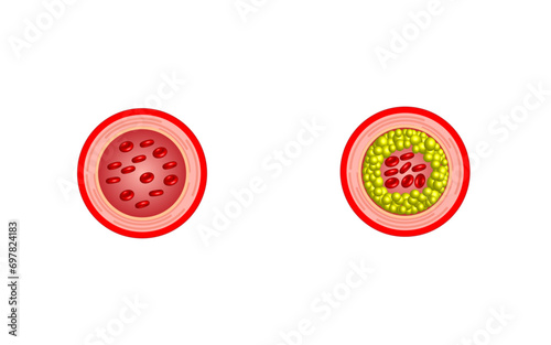 Atherosclerosis, normal artery versus narrowed artery blocked with cholesterol plaque. Blood vessel blocked with a clot. High cholesterol level as atherosclerotic risk. Vector illustration.