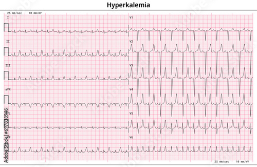 ECG Hyperkalemia - Hyperkalaemia - 12 Lead ECG Common Case - 6 Sec/lead - Vector Medical Illustration