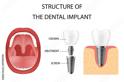 Dental implant. Realistic implant structure, graphic models of the crown. Screw prosthesis, orthodontic dental implantation