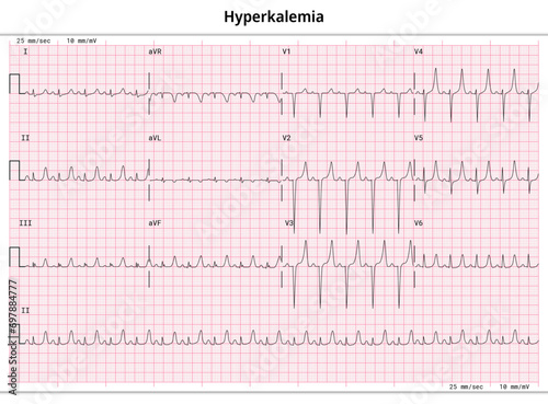ECG Hyperkalemia - Hyperkalaemia - 12 Lead ECG Common Case - 3 Sec/lead - Vector Medical Illustration