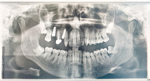 Foto Tooth rx