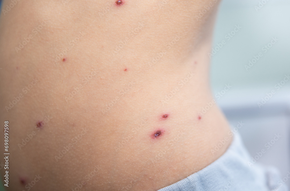 The child has spotted red pimples and a blistering rash from chickenpox or the varicella zoster virus. Viral disease in children. Red pimples all over the body. Infection.
The child has spotted red pimples and a blistering rash from chickenpox or the varicella zoster virus. Viral disease in children. Red pimples all over the body. Infection.