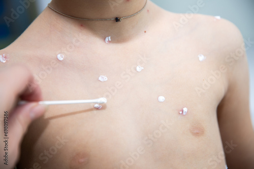 A child suffers from a viral disease - varicella chickenpox. Red pimples on the body. Lubricating acne with a special cream on a cotton swab.
 photo