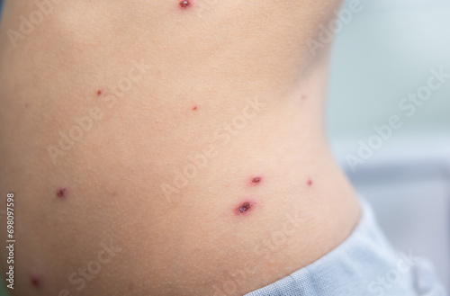 The child has spotted red pimples and a blistering rash from chickenpox or the varicella zoster virus. Viral disease in children. Red pimples all over the body. Infection.
 photo