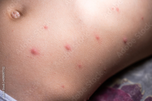 The child has spotted red pimples and a blistering rash from chickenpox or the varicella zoster virus. Viral disease in children. Red pimples all over the body. Infection.
 photo