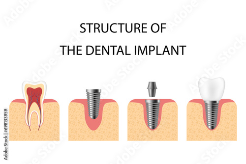 Dental implant. Screw prosthesis, orthodontic dental implantation
