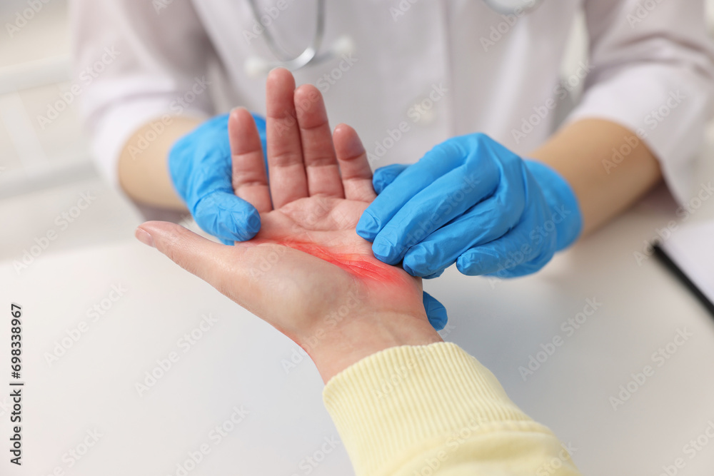 Obraz premium Doctor examining patient's burned hand indoors, closeup
