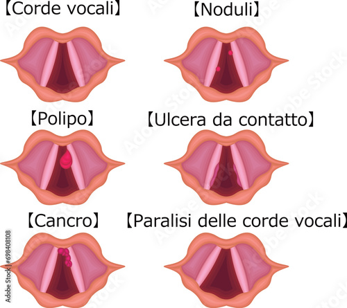 声帯　病気　種類　構造　イラスト　イタリア語