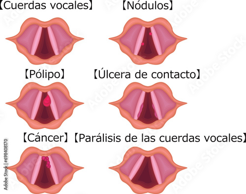 声帯　病気　種類　構造　イラスト　スペイン語