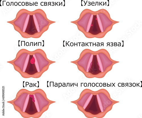 声帯　病気　種類　構造　イラスト　ロシア語
