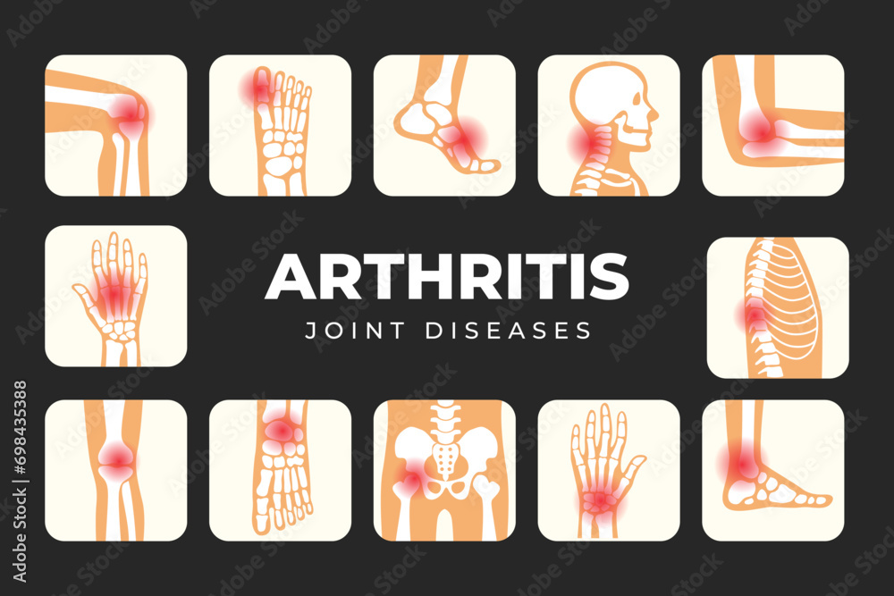 Set of different types of Arthritis infographic poster, Joint disease ...