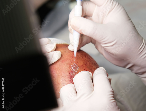 Close-up hair transplant operation in operating room of doctor in white gloves.Solution to baldness