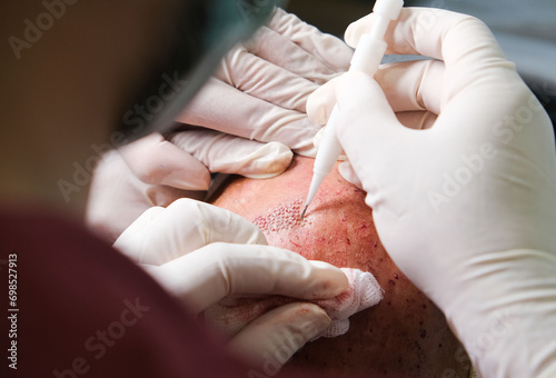 Hair transplant surgery with dhı pencil in close-up. The hands of the doctor performing the hair transplant and the patient's scalp. photo